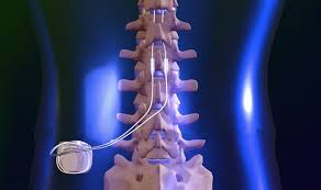 spinal stimulation, for chronic pain and balance