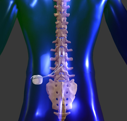 spinal cord stimulator 166,000.00 dollar conveyer belt
